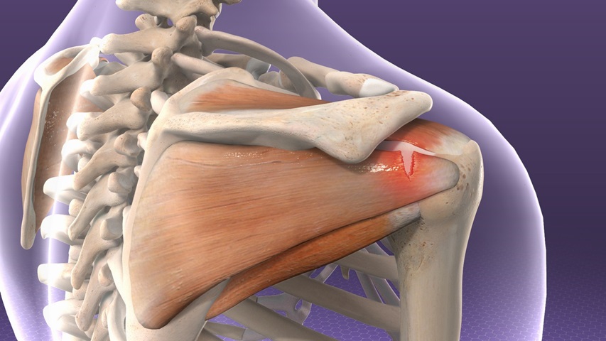 rotator cuff tear