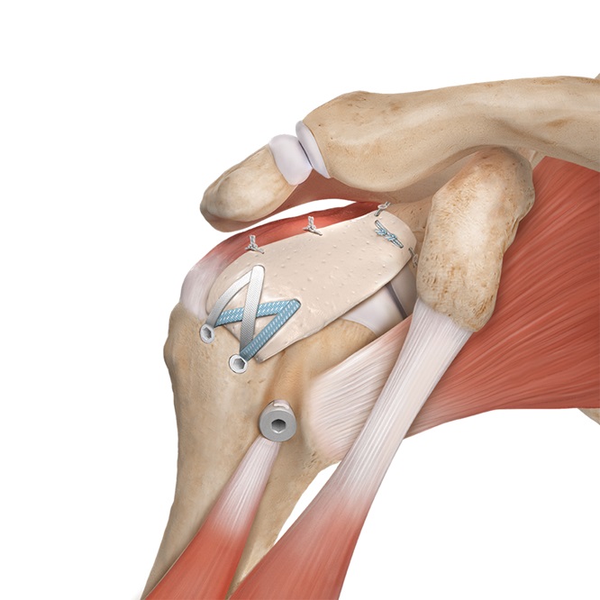 rotator cuff tear